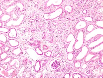 chronic interstitial nephritis