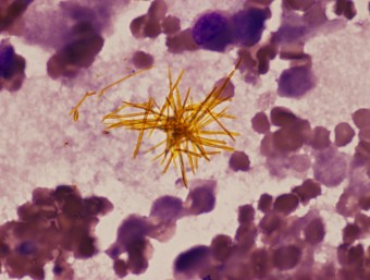 crystal of bilirubin, haematuria, urine sediment, dog