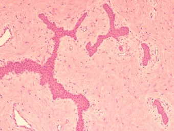 fibromatous epulis of periodontal ligament,dog