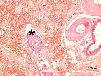 intravascular metastatic mammary carinoma in skin, dog