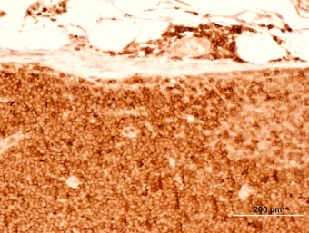 lymphoma, lymphonode, dog, imunohistochemistry CD3