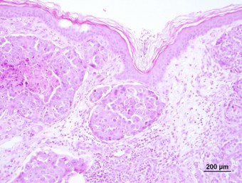 metastases of mammary ca in the skin via lymphatics,dog