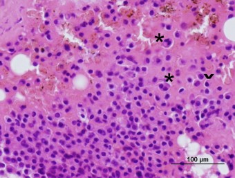multiple myeloma, bone marrow, detail