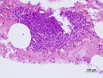 multiple myeloma, bone marrow, dog