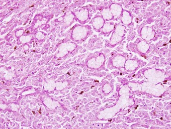 oral melanoma, invasion to salivary gl.,dog