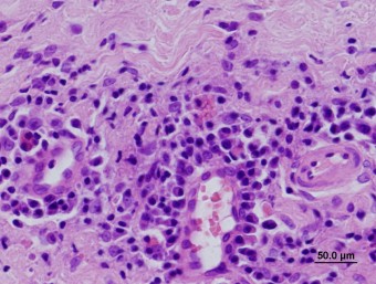 stomatitis, calicivirosis, Mott cells,cat