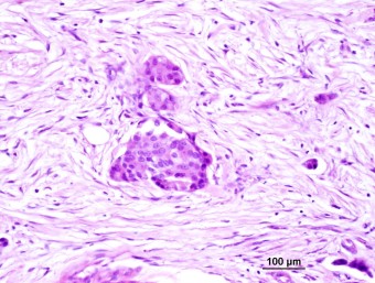transitory cell ca, urine bladder, emboli in lymphatics,dog