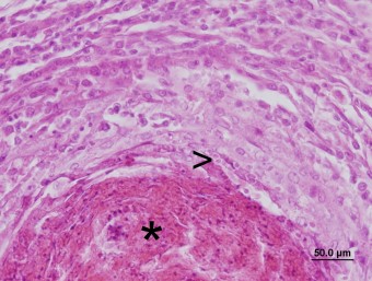 amoebic granuloma liver, tench